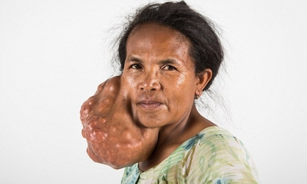 Người phụ nữ với khối u nặng 5 kg trên mặt